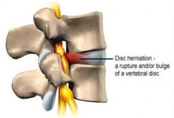 Spinal-Decompression-Therapy